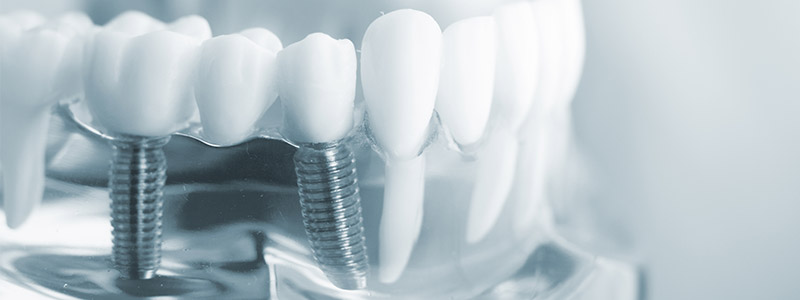 Zahnimplantate in Sindelfingen / Feste Zähne an einem Tag